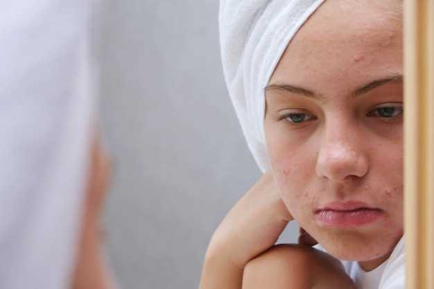 Treating acne while using Finasteride