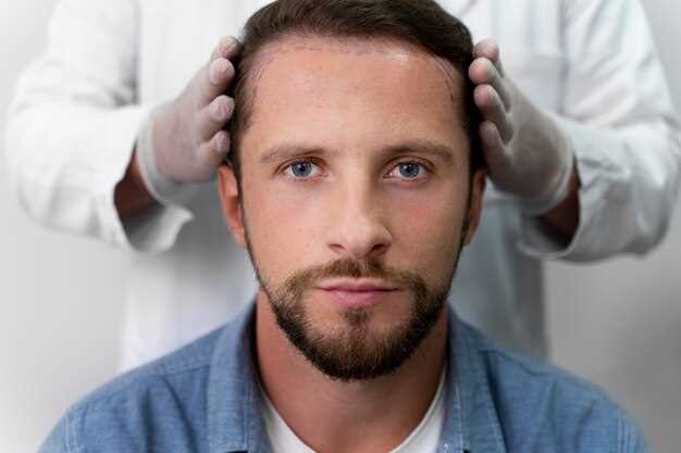 Finasteride alopecia costo