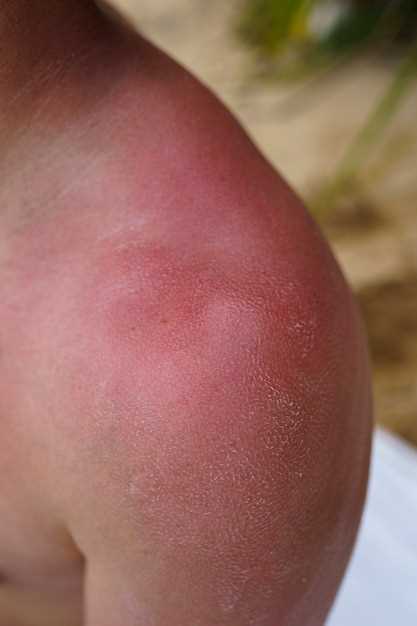 Finasteride and skin rash