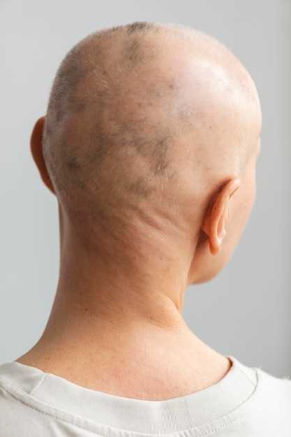 Finasteride female baldness