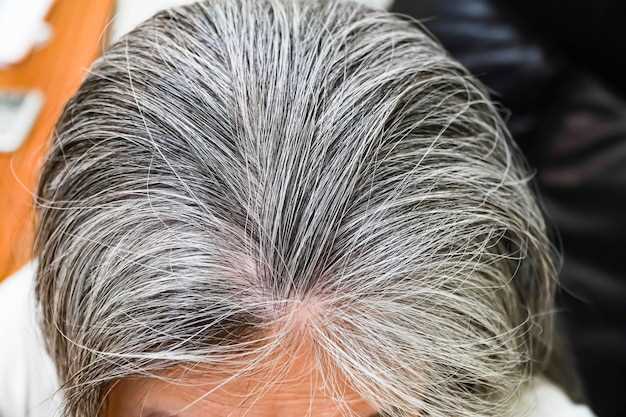 Finasteride mature hairline