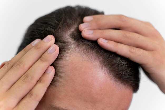 Finasteride scalp irritation